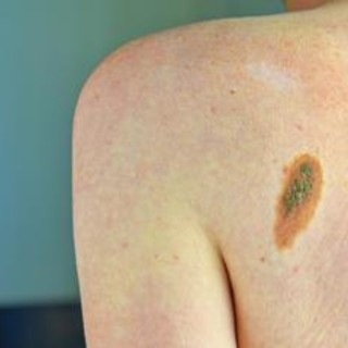 Melanoma in stadio avanzato, grazie a terapie migliora sopravvivenza